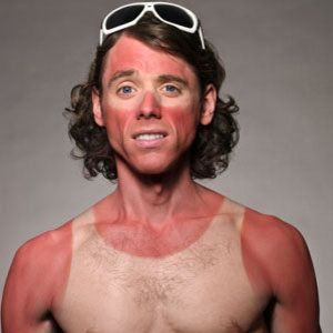 sunburn-medium_new